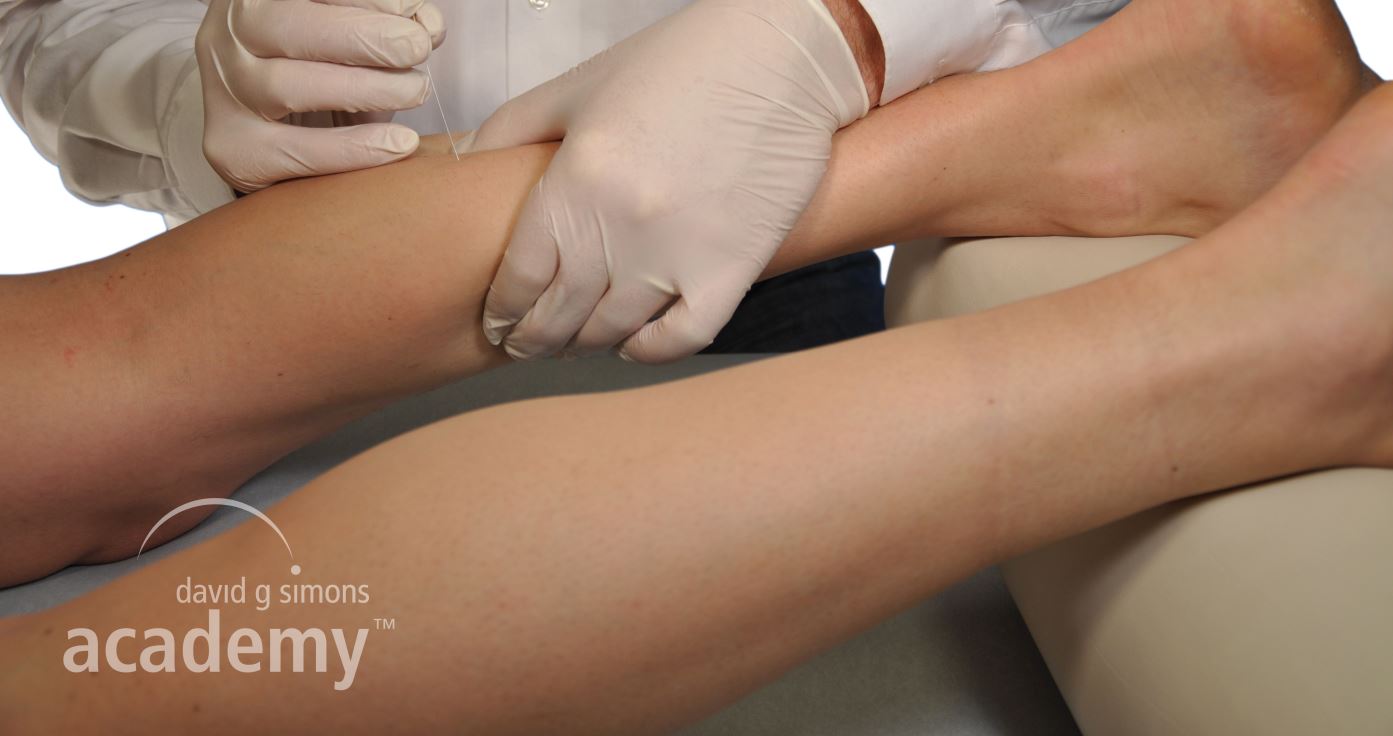 Dry Needling of the gastrocnemius muscle. There are two forms of Dry Needling: intramuscular Dry Needling or superficial Dry Needling. (© Copyright – David G. Simons Academy, DGSAⓇ)
