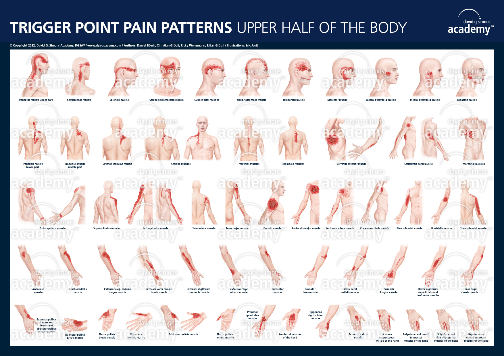 Trigger Point Pain Patterns